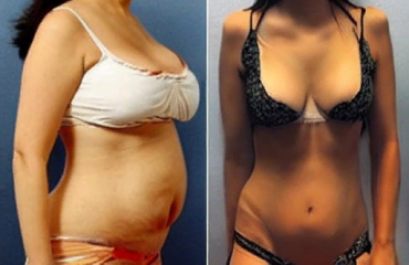 Plastic surgery after weight loss